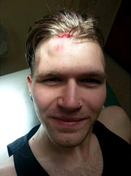 Elliot Oaten face injury selfie